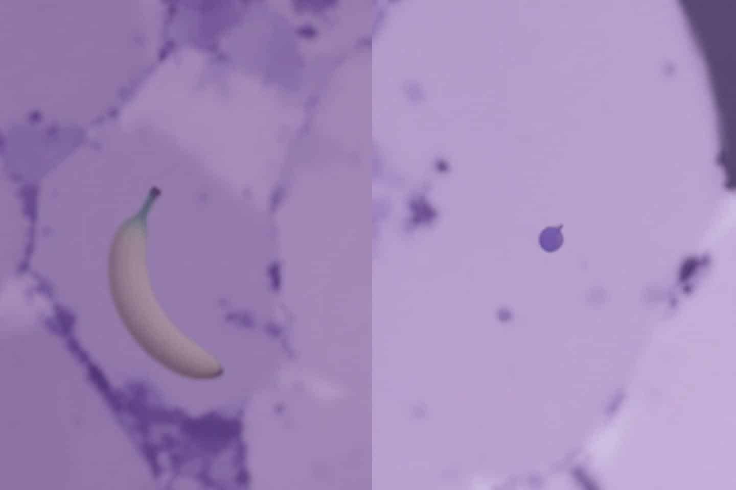 Banane et calcul biliaire : Bonne ou mauvaise association ?