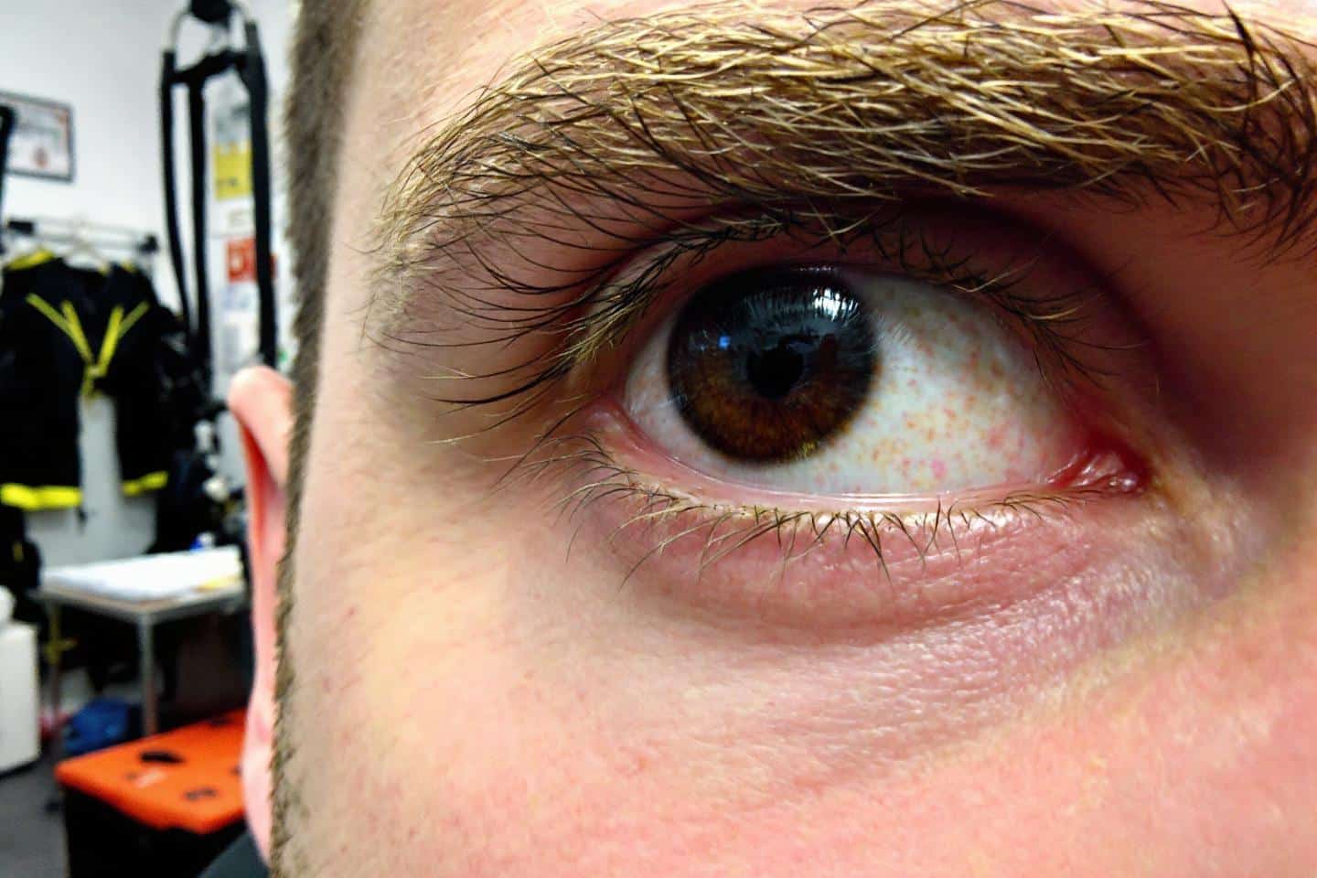 Iridologie exemple : Comment les yeux révèlent vos faiblesses organiques ?